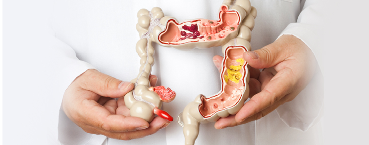 Affordable Cost of Colon Cancer Treatment India